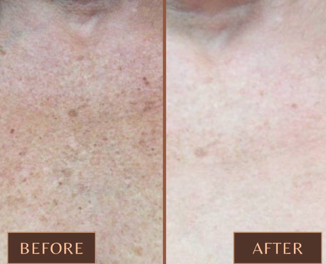 Pigmentation & Vascular Correction