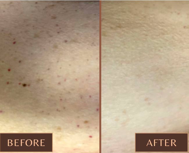 Pigmentation & Vascular Correction