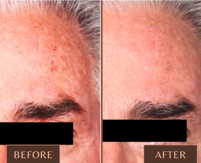 Skin Rejuvenation